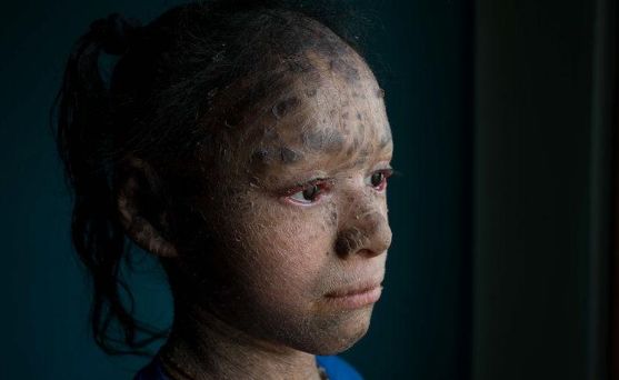 印度一女孩患罕见病全身鱼鳞被人称蛇女白天不敢出门故事