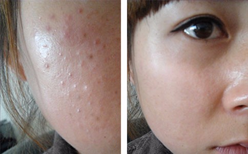 脸上小疙瘩像鸡皮肤(脸上都是小疙瘩像鸡皮) 脸上小疙瘩像鸡皮肤(脸上都是小疙瘩像鸡皮)