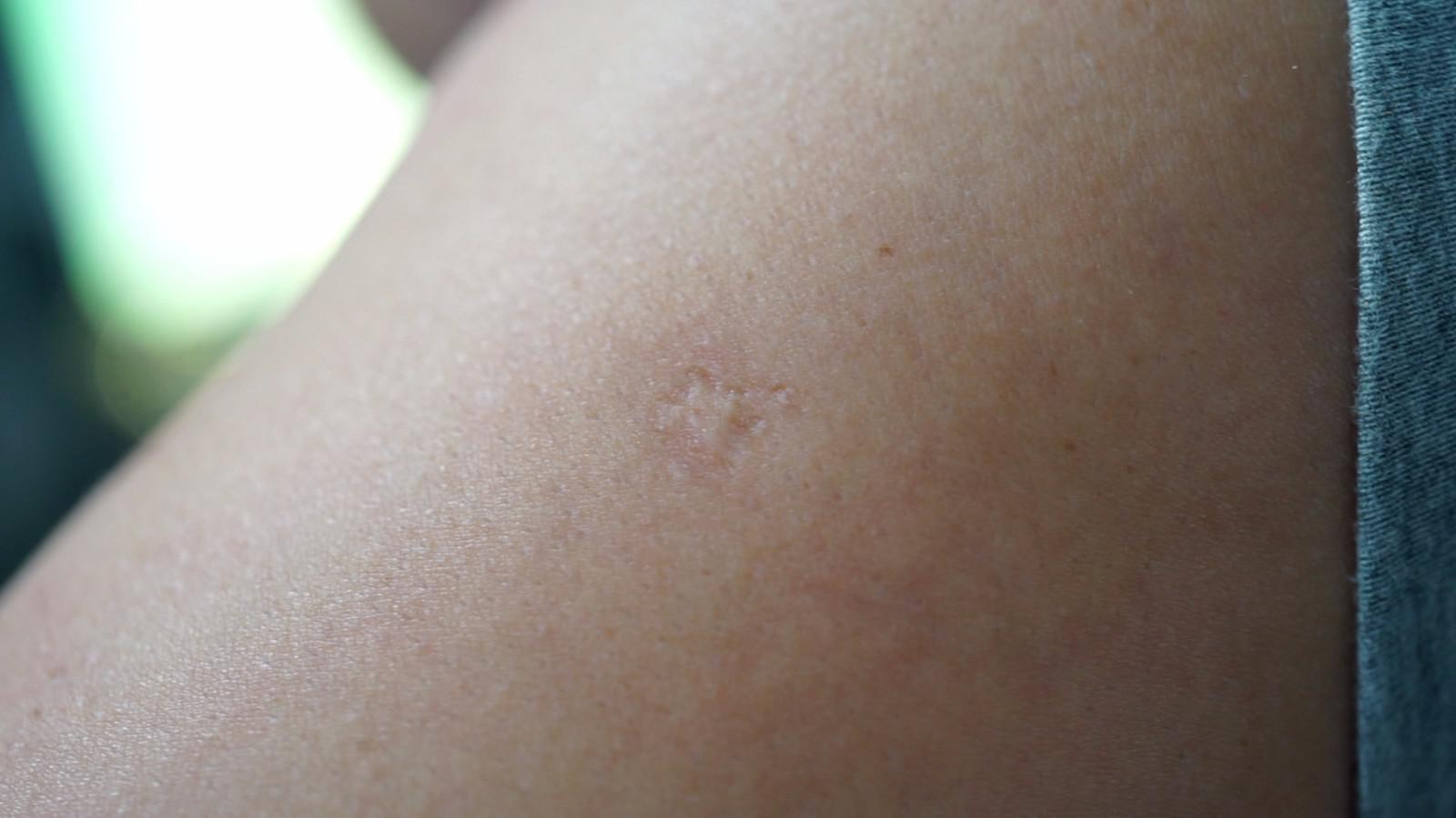 为什么打疫苗后,胳膊上会印个"梅花"?今天就告诉你