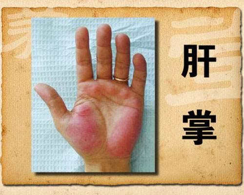 肝不好的人手上会有这4个现象你若没有说明你肝很好