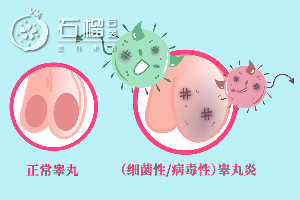 腮腺炎|流行性|睾丸炎_新浪新闻