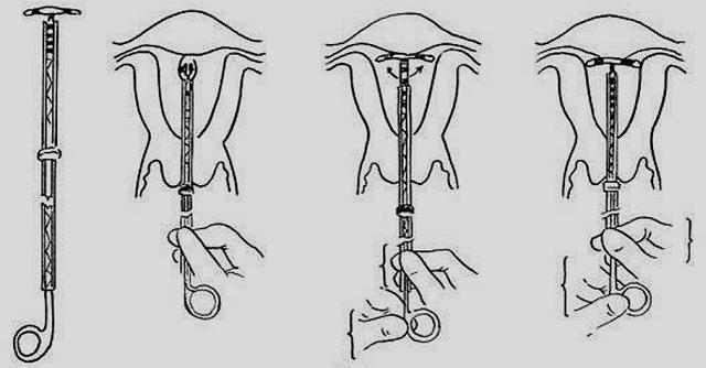 到底要不要上节育环,有想法的先看看这4点再决定吧|避孕|节育环|孟梦