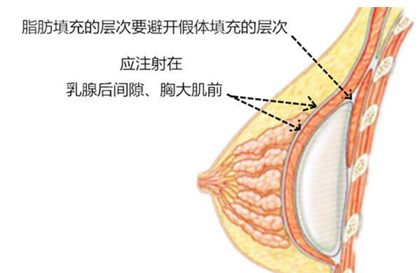 假体丰胸和自体脂肪丰胸可以同做吗?有哪些危害?
