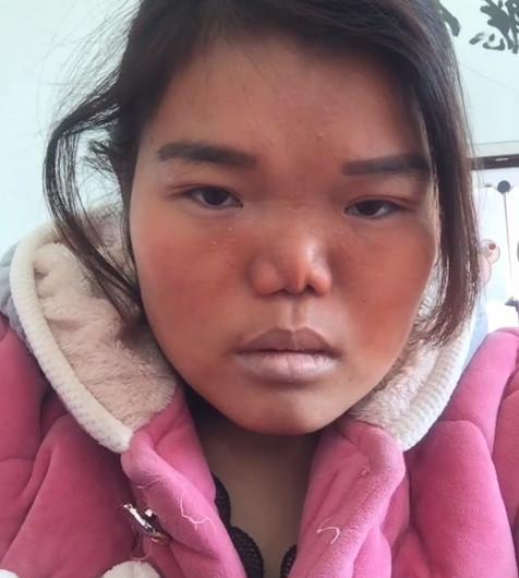 女子有个大蒜鼻子, 割了双眼皮还要整鼻子, 结果让人很满意