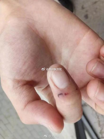 郑州一男孩被老鼠咬伤保险公司动物咬伤不在理赔范围