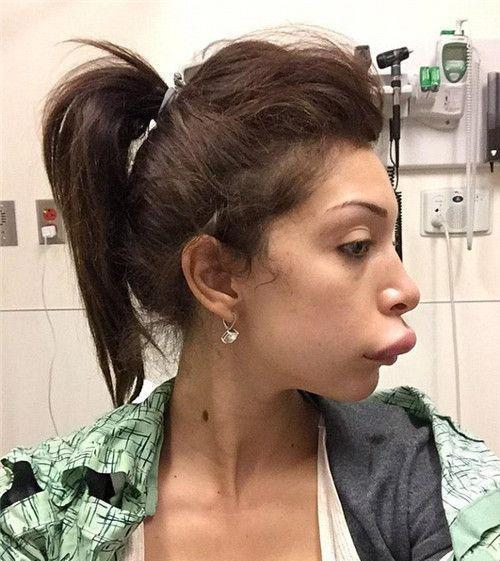 漂亮女子整容失败,嘴巴变成了"鸭子嘴",丑得不敢照镜子!