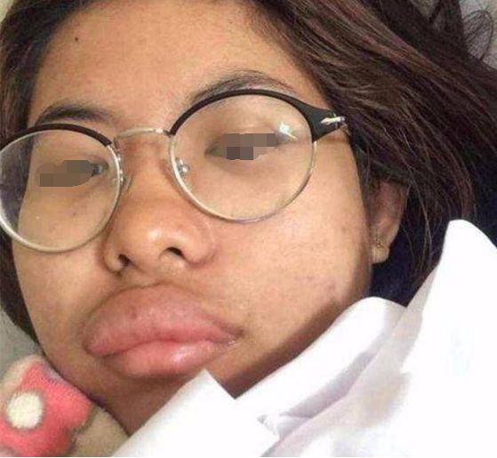 女子一觉醒来,嘴唇竟变成了"香肠",检查后连医生都忍不住笑了