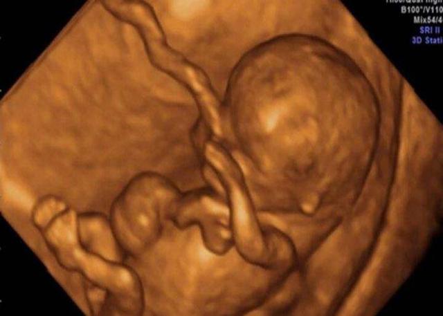 四维彩超3个关键数据,关乎着胎儿是否健康,孕妈一定要问清楚