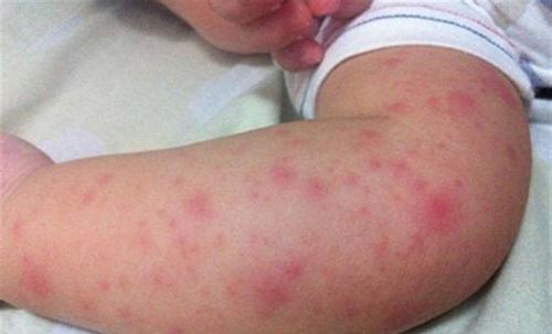 过敏|湿疹|宝宝_新浪新闻