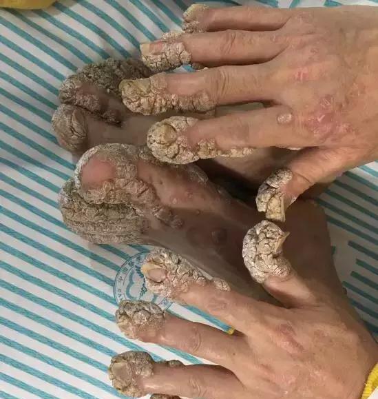 惊!南京出现罕见"珊瑚人"!