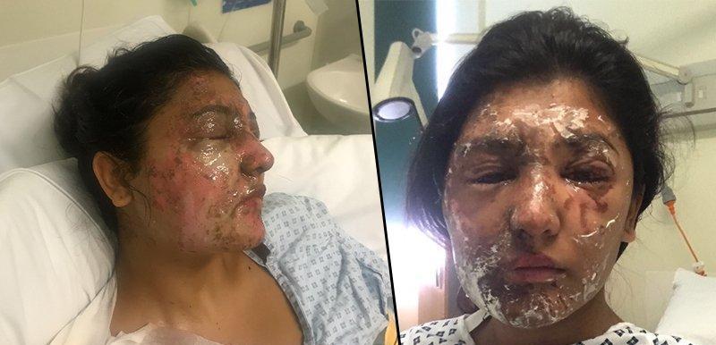 她被硫酸毁容, 3个月后神奇康复变得更美了