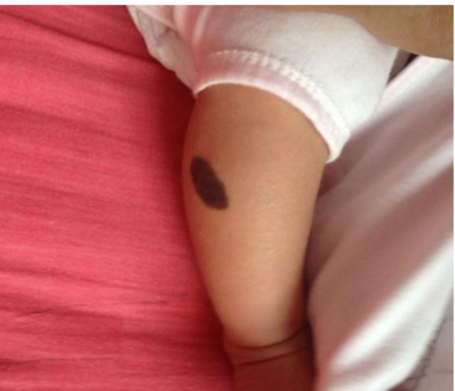 宝宝出生时有4块胎记!有这6个坏习惯,胎儿特意容易长胎记