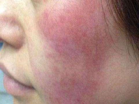 脸上能够挤出黄颗粒,这是毛囊虫的信号!要小心