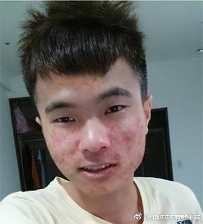 男人脸上长痘痘是什么原因?