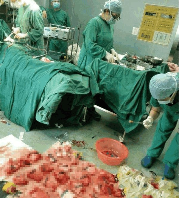 剖腹产过程中, 产妇说胸闷想吐, 在场医生脸瞬间惨白了|产妇|李琴|医