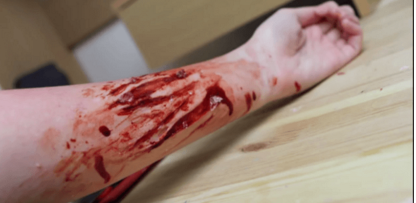 女孩给手臂化受伤妆看起来伤势十分严重只为向老板请个假