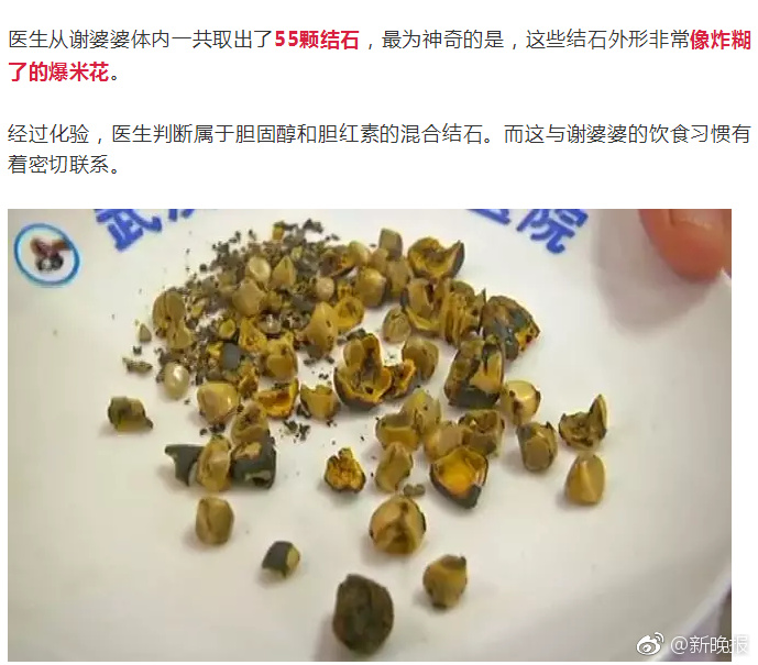 女子常年不吃肉,长了胆结石