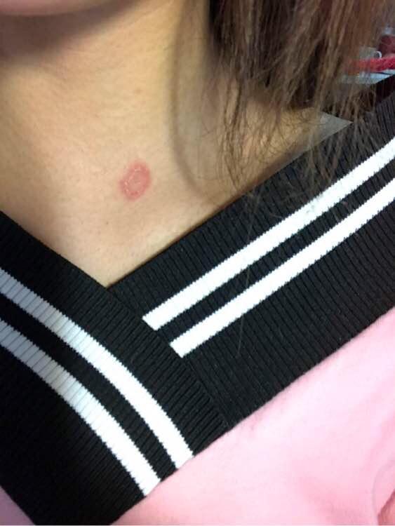 领养了小猫后,手上长了几颗东西,一直很痒,怎么回事?