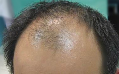 发际线后移是指人头皮额头部外圈的头发,而随着年龄的增长,发圈的这些