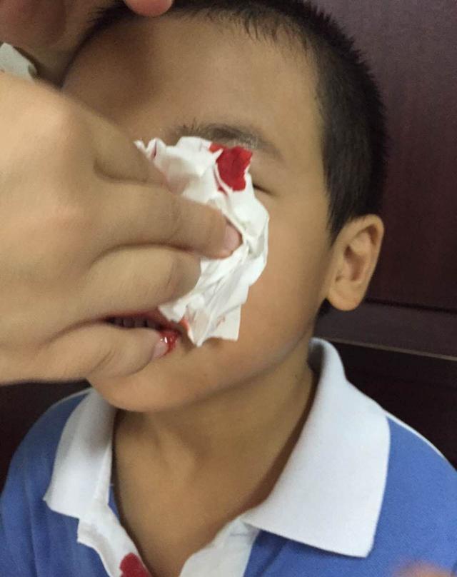 宝宝流鼻血, 把头仰起来吗?