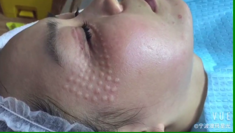 肉毒毒素瘦腿夏季到了,瘦腿的mm越来越多了,一次注射可维持4-6个月,规