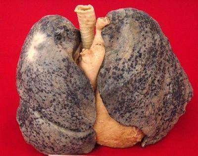 吸烟人的肺 十年图片