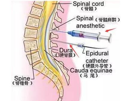 老公坚决不同意无痛分娩称麻药会影响宝宝智商宁可痛死也不打