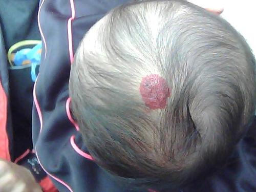 以为是虫子咬的或者是碰的,让去医院检查一下医生说是血管瘤,帮妈今天