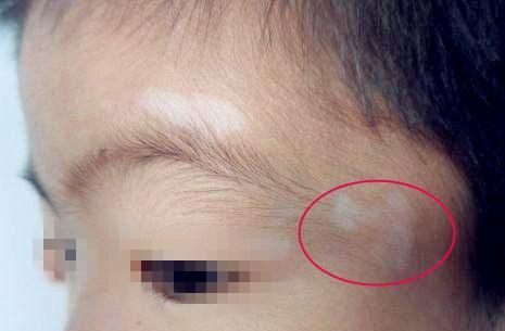 孩子这几个症状就是肚子长了蛔虫