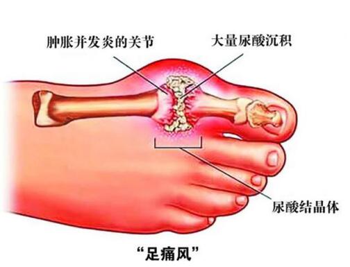 疼痛缓解快,急性发作期可出现明显的单关节如足第一趾跖关节,踝关节等