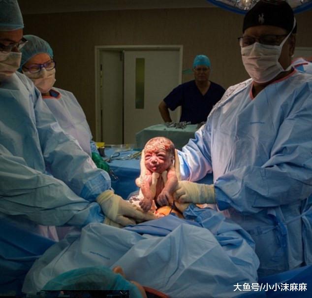太牛了! 这个产妇亲手从子宫里把孩子取出来!