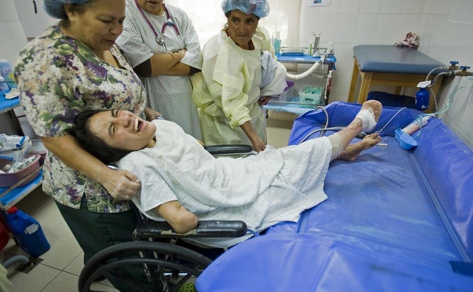 这位来自危地马拉的女孩,今年才16岁,但是她却因为触电而失去了自己的