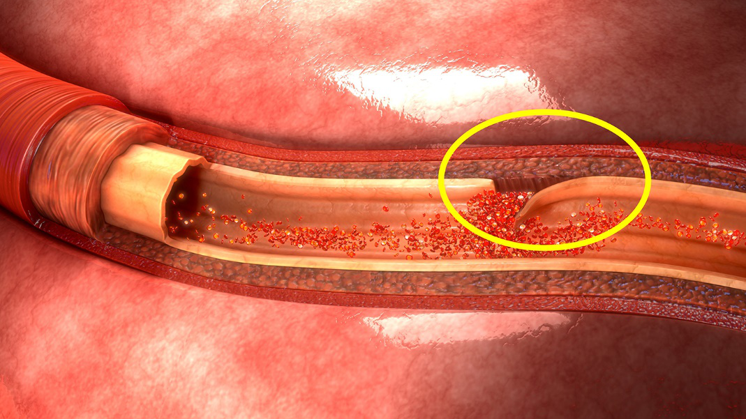 动脉夹层凶险难治,动手术的治愈率高吗?听听中南教授的解答