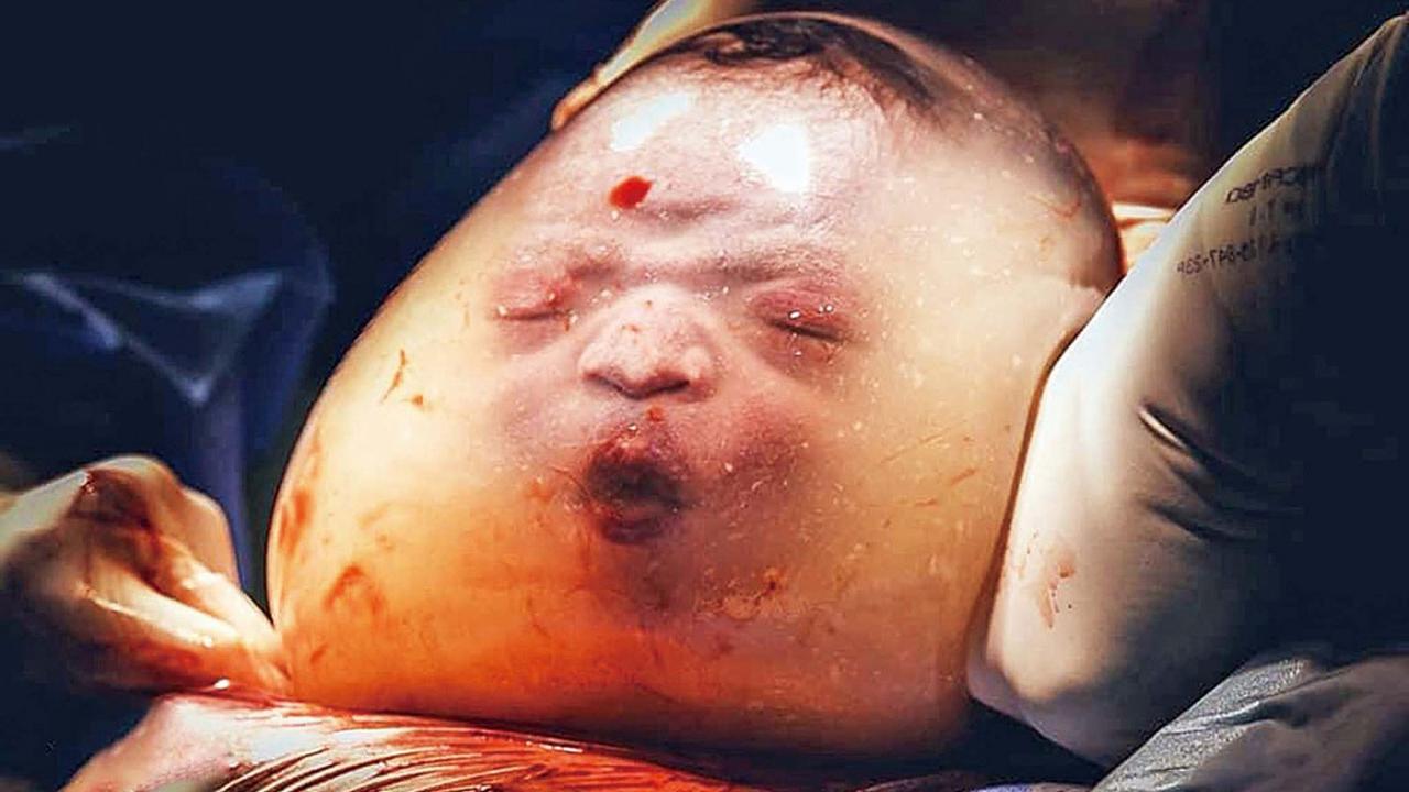 国外婴儿羊水未破出生像一个小肉球网友哪吒转世