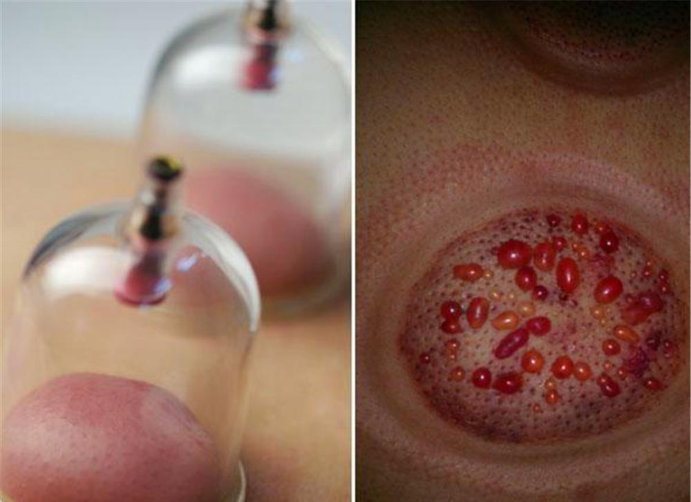 出现水泡,除了说明湿气的现象,还有的是因为操作不当,拔罐时间过长