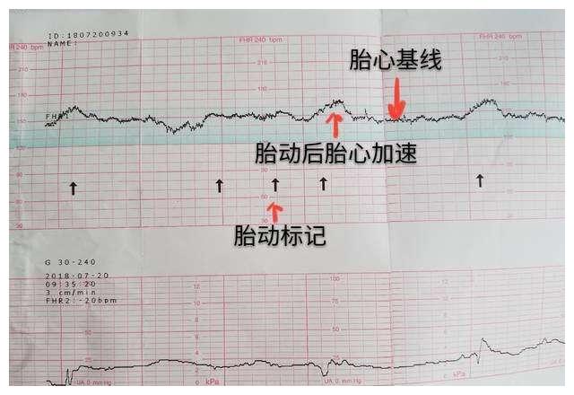 胎心監護時胎兒不動怎麼辦?做胎監注意事項,以及過來人經驗分享