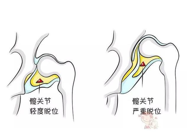 宝宝腿纹臀纹不对称就是髋关节发育不良吗为啥说越早发现越好
