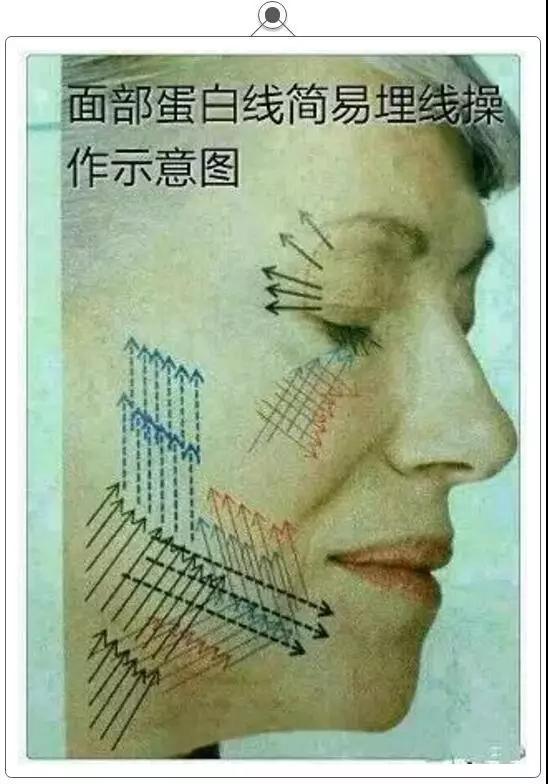 大v线提升面部好吗,有副作用吗?