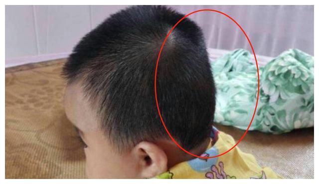 5个月女儿后脑勺平得像"煎锅",宝妈一个动作补救,医生都称赞