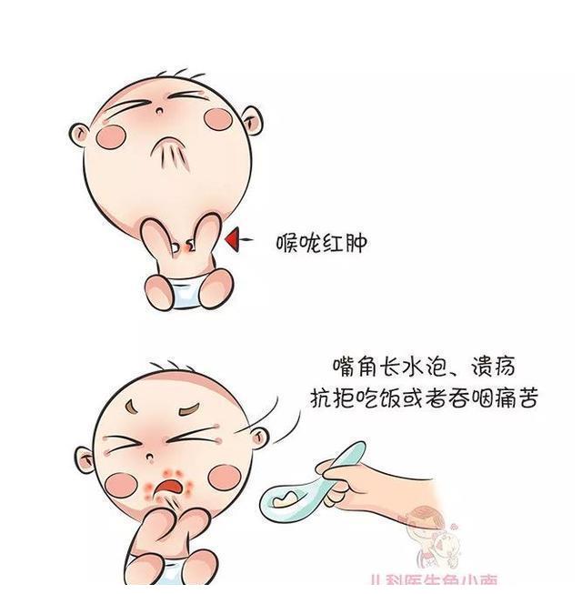 比如宝宝边流口水边发烧鼻涕的,还有吞咽困难甚至肉眼可见喉咙红肿,很
