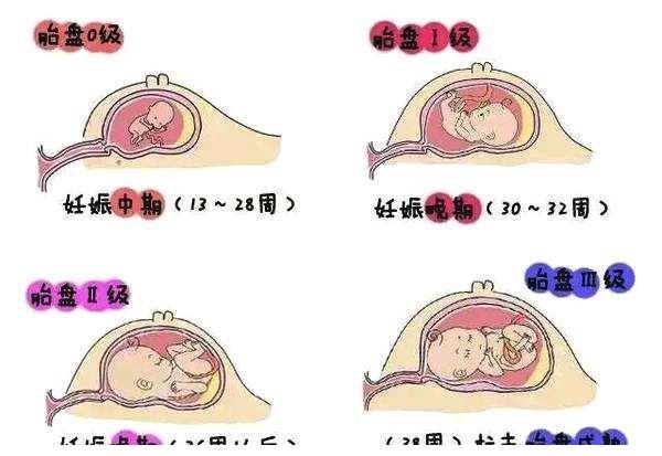 胎盘等级和孕周怀孕33周做b超却显示36周胎宝会提前出生吗