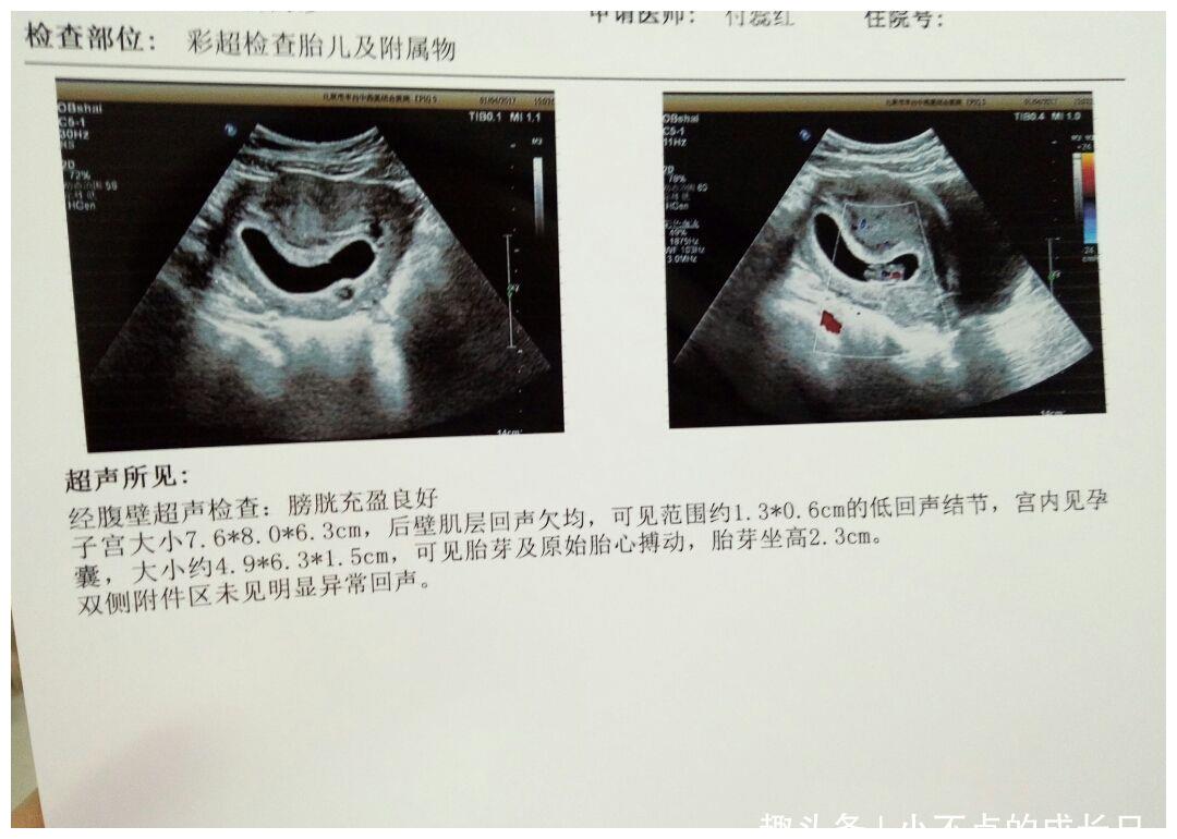 话,那么可能是一位小美女,如果胎囊的形状不规则,而且呈现长条形的话