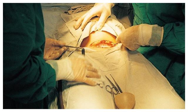 剖腹产没有那么简单,看完剖腹产全过程,经历过的都感叹自己胆大