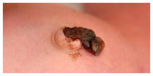 新生儿肚脐该如何护理?这5点最好关注一下!