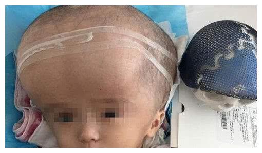 "大头娃"再现,那些11年前喝过三鹿奶粉的孩子,现在这副模样