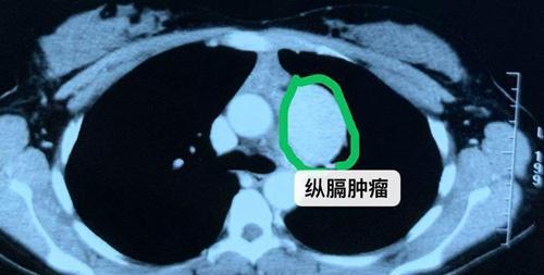 18岁女孩长了胸腺瘤,微创手术为女孩保住了胸部美观