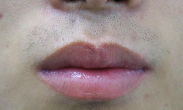 嘴唇变成紫黑色,是什么原因引起的?别慌,现在知道还来得及