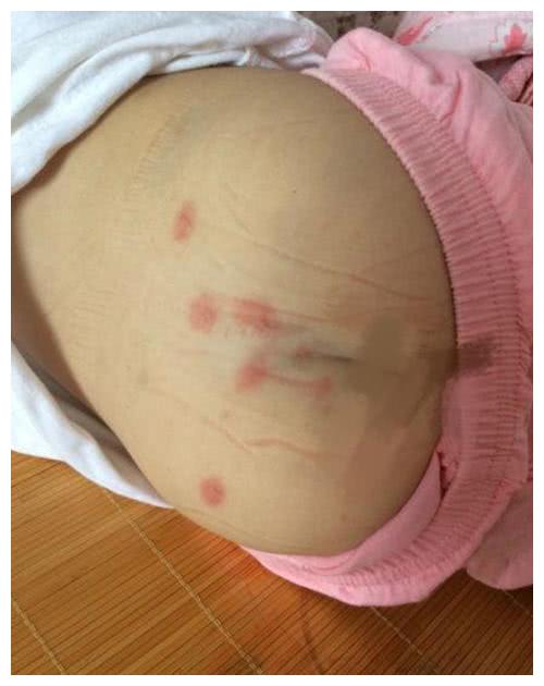 6岁女儿总说屁屁痒,看到检查结果,妈妈无法淡定