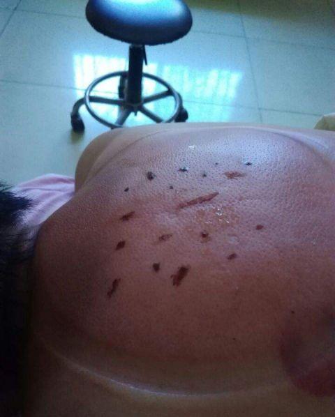 拔火罐留下的紫印是什么听听中医专家怎么说