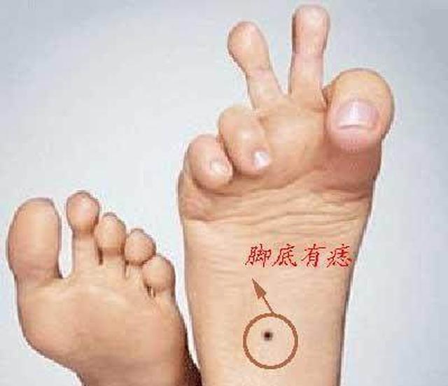 如果在脚底有朱砂痣也就是红色的痣,这样的人不仅自己属于富贵命格